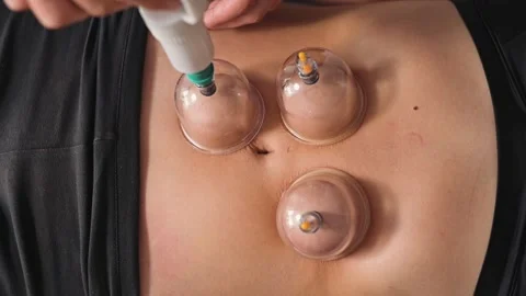 In a clinical setting, a practitioner performs a manual cupping therapy Видео 344380250