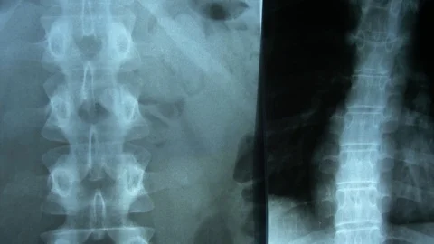 Clinician Examining X-Ray Image Of Patient's Spine and Chest POV Stock Footage