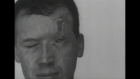 Clips showing the usage of plastic surgery, Scotland, United Kingdom, UK, 1948 Stock Footage 134037080
