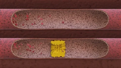 Clogged Artery with cholesterol platelets Stock Footage 75653840