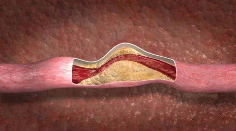 Clogged Artery Stock Footage 29336846