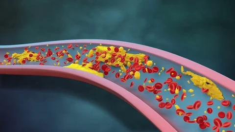 Clogged Artery Stock Footage 74207022