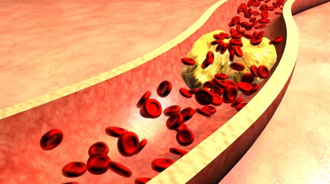 Clogged Artery with platelets and cholesterol plaque Stock Footage