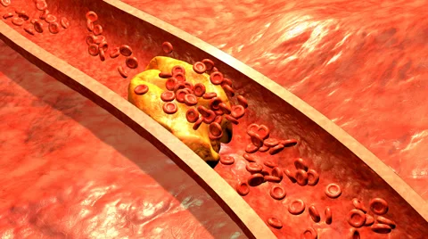 Clogged Artery with platelets and cholesterol plaque Stock Footage 59795238