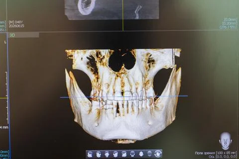 Close-up of a 3D maxillofacial bone reconstruction displayed on dental cone.. Stock Photos