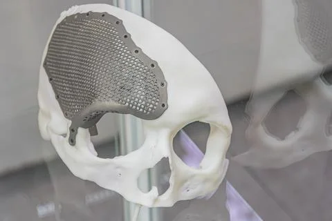 Close-up of a 3D printed titanium denture prosthetic attached to an artificia Stock Photos