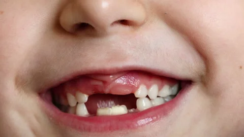 Close-up of a 6-7 year old girl with newly erupting teeth. Loss of milk teeth Stock Footage 166320845
