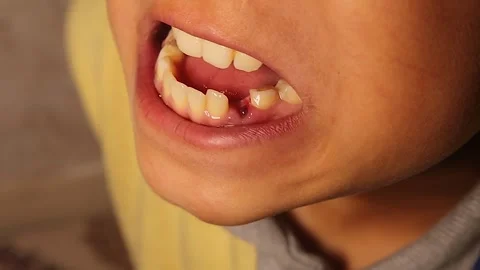 Close-up of 9-year-old child with missing milk incisor, clean healthy teeth care Stock Footage 318206822