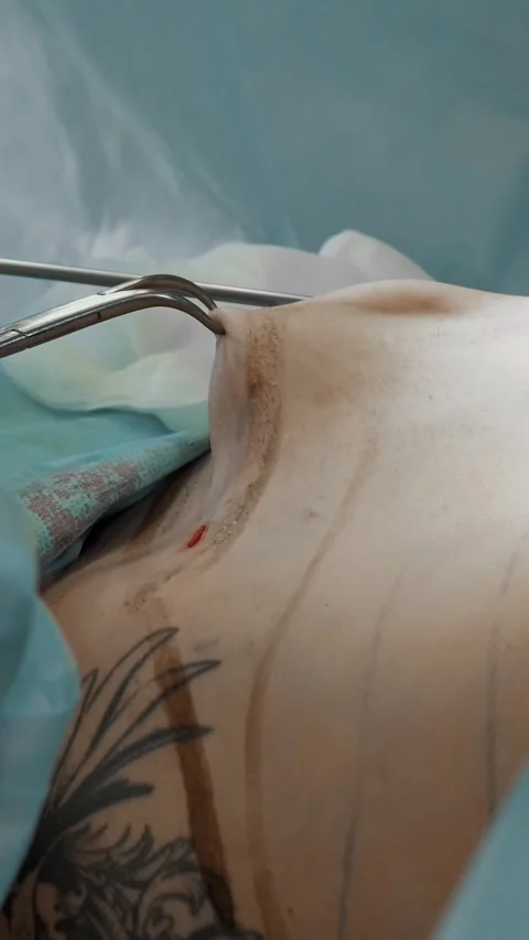 Close-up. abdominal liposuction, surgery in actual operating room. surgeon pumps Stock-Footage 317158971
