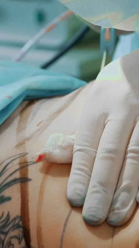 Close-up. abdominal liposuction, surgery in actual operating room setting Stock-Footage 318806345