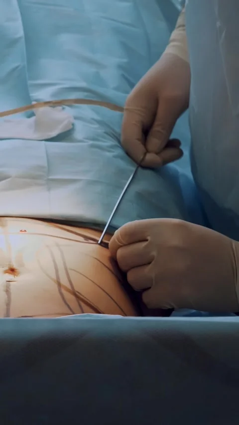 Close-up. abdominal liposuction. surgery. the surgeon pumps out the fat through Stock-Footage 316261749
