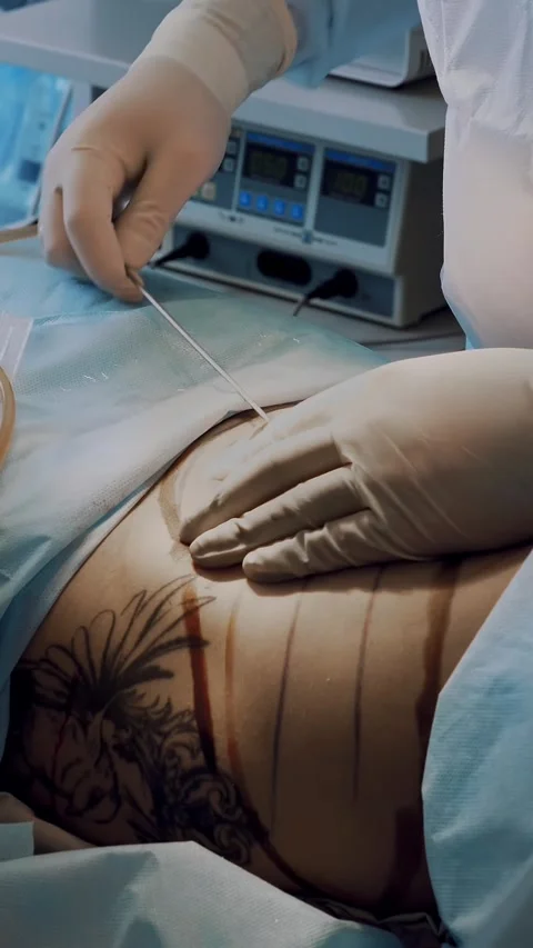 Close-up. abdominal liposuction. surgery. the surgeon pumps out the fat through Stock-Footage 316984596