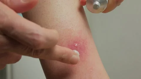 Close-up of an abscess from an insect bite on a woman's leg. A woman treats the Stock Footage 155283706