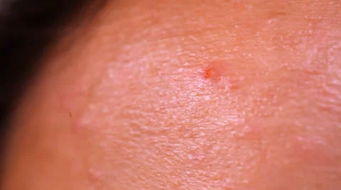 Close up of Acne skin because the disorders Of sebaceous glands productions. Видео 39849232