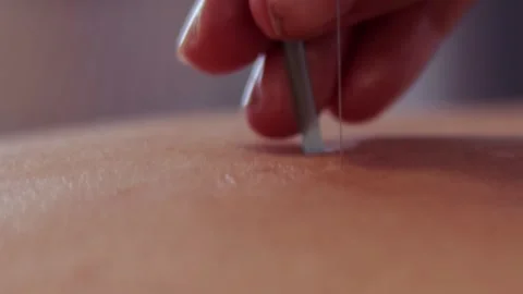Close up of acupuncture therapy needle Stock Footage 301623551