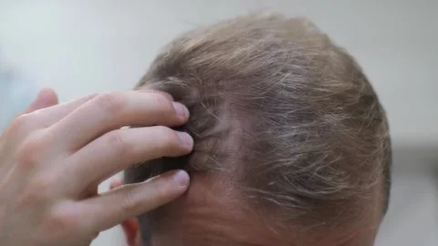 Close-up of an adult man with thin, sparse, falling hair Video stock 296018292
