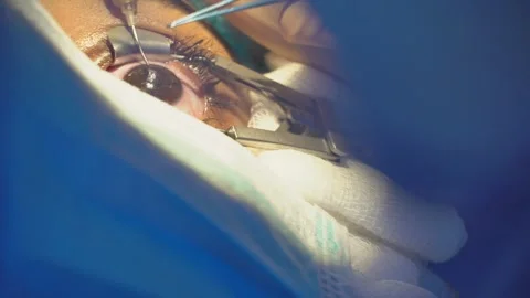 Close-up of advanced ophthalmology procedure with laser treatment, lens Stock Footage 294686946