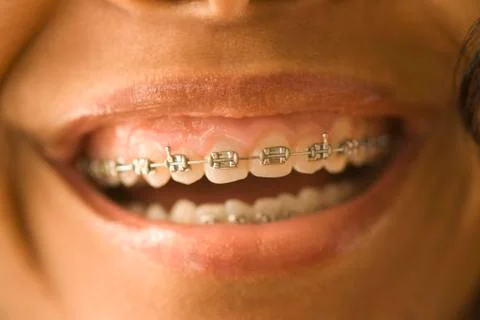Close up of African woman with orthodontic braces Stock Photos