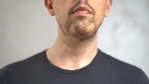 Close up of alopecia areata on beard Vídeo Stock 126921260