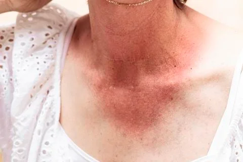 A close up and front view on the severely burned skin of a mature caucasian w 스톡 사진