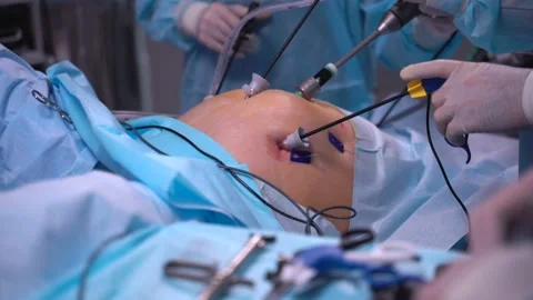 Close up ands of surgeons during operation with surgical laparoscopy instruments Stock Footage 221128518