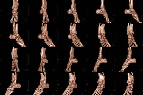Close up ankle x ray 3d Stock Photos