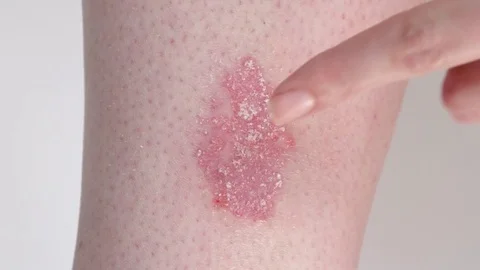 CLOSE UP: Applying anti-inflammatory corticosteroid cream for psoriasis on skin Stock Footage 85017792