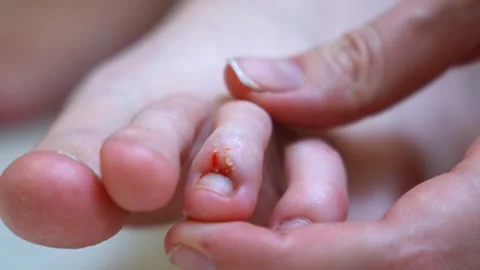 Close-up of applying cream to a wounded toe Stock Footage 326148892