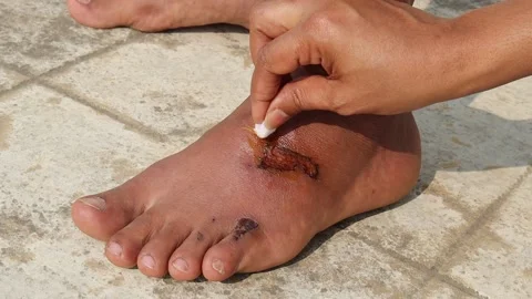 Close up of applying ointment on an semi dried wound on the man feet Stock Footage 238847342