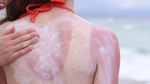 Close-up of applying sunscreen to the skin Stock Footage 315446377