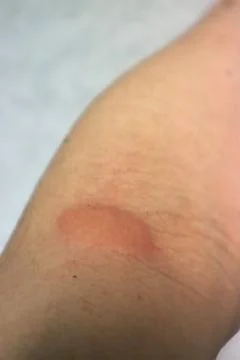 Close-up of an arm with a mosquito bite Stock Photos