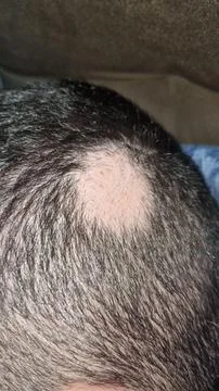 Close-up of bald area on head Stock Photos