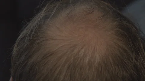 Close up of bald spot on man's head Stock Footage 122085268