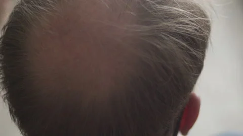 Close up of bald spot on man's head. Head slowly turning Stock Footage 150190448