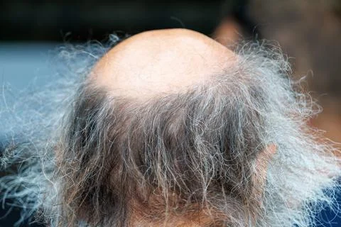 Close-up of balding head with sparse gray hair Stock Photos