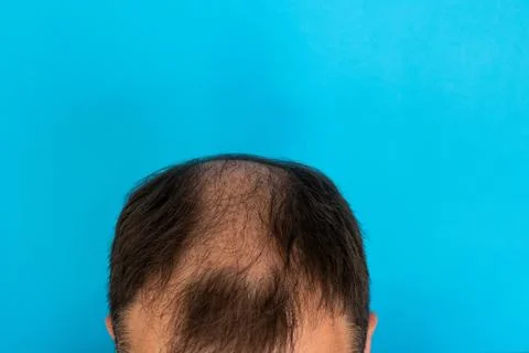 Close-up of a balding head of a young man on a blue isolated background. Stock Photos