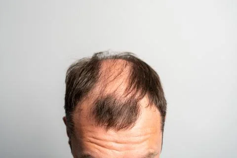 Close-up balding head of a young man on a on gray isolated background. Stock Photos