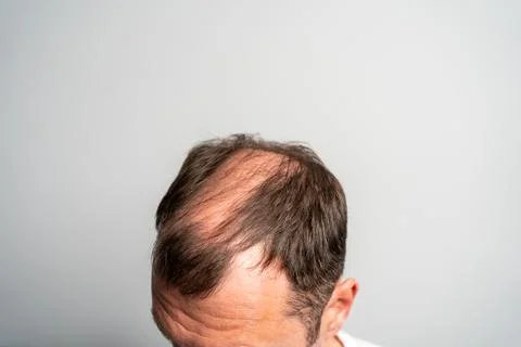 Close-up balding head of a young man on a on gray isolated background. Stock Photos