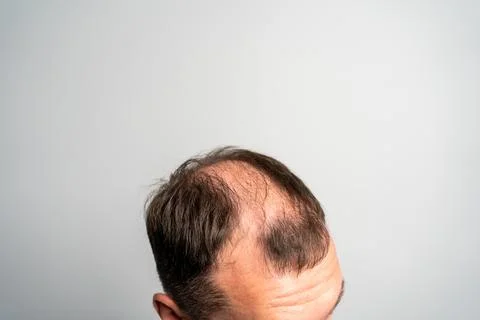 Close-up balding head of a young man on a on gray isolated background. Stock Photos