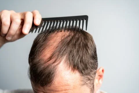 Close-up balding head of a young man on a on gray isolated background. Stock Photos