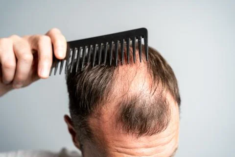 Close-up balding head of a young man on a on gray isolated background. Stock Photos