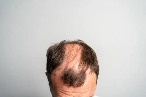 Close-up balding head of a young man on a on gray isolated background. Stock Photos