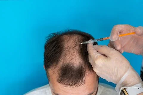 Close-up of a balding head of a young man on a blue isolated background. Stock Photos