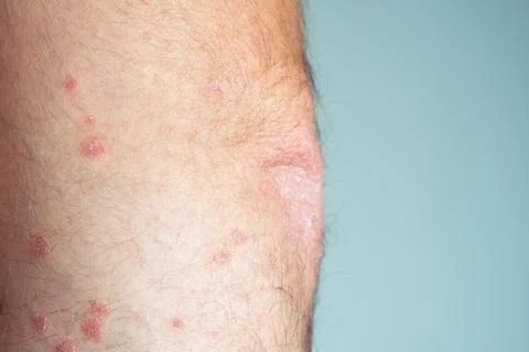 Close-up of bare elbow of unrecognizable man showing red flaky skin suffering Stock Photos