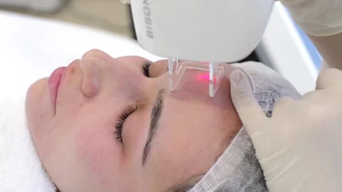 Close up beauty procedure. Laser face peeling. Stock Footage 87967347
