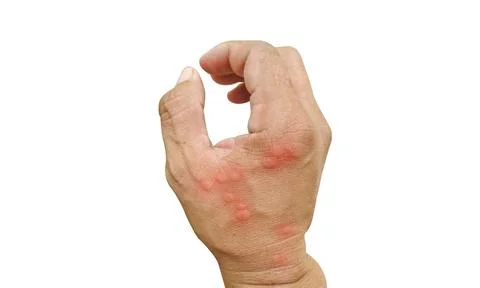Close-up Bee: stinging hand insects worker skin allergy, allergic treatment.. Stock Photos