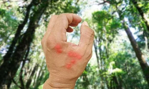 Close-up Bee: stinging hand insects worker skin allergy, allergic treatment.. Stock Photos