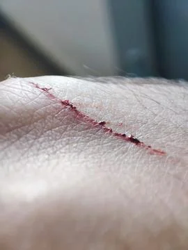 Close-up of bleeding wound on human hand skin. Stock Photos