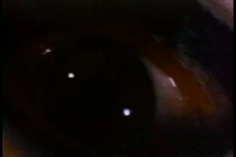 Close-up of blinking bloodshot eye Stock Footage 11352903