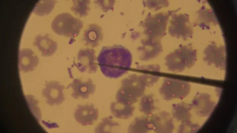 A close-up of blood cells under microscope view. Abnormal cells in blood. Body Video stock 110296769